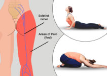 Yoga for Sciatica: 10 Best Yoga Poses To Relief From Sciatica Pain