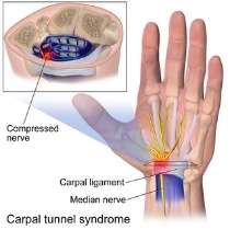 Yoga for Carpal Tunnel Syndrome: 8 Hand Yoga Stretches for Pain