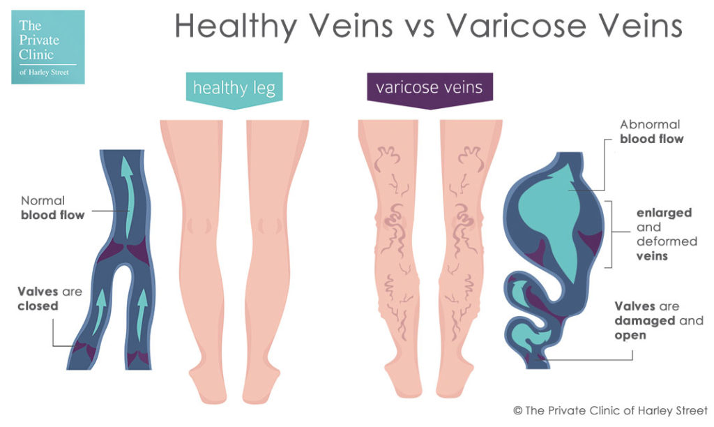 healthy-veins-vs-varicose-veins