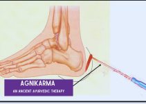 Agnikarma(An ancient ayurvedic therapy)